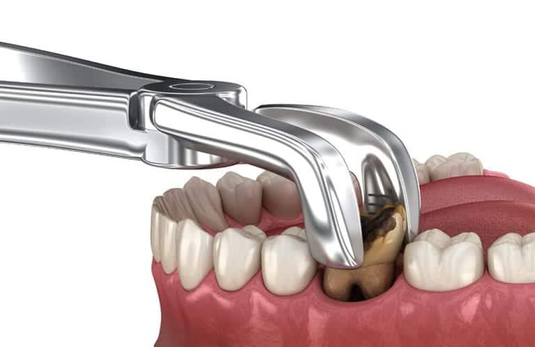 https://mydentalkraft.com/wp-content/uploads/2022/11/Tooth-Extraction1.jpg