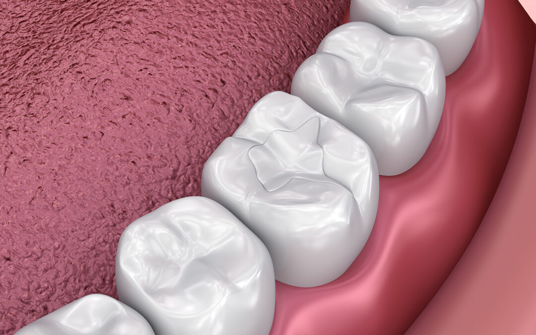 Fissure dental fillings, Medically accurate 3D illustration