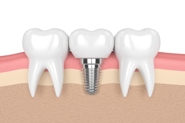 https://mydentalkraft.com/wp-content/uploads/2022/11/dental-implants-2202.jpg