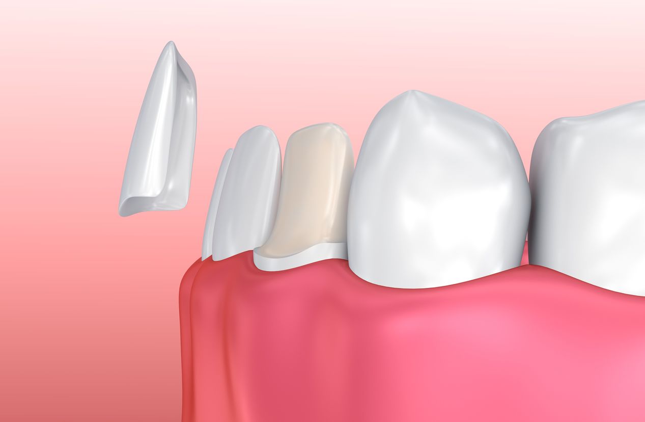 https://mydentalkraft.com/wp-content/uploads/2022/11/iStock-621830860.jpg