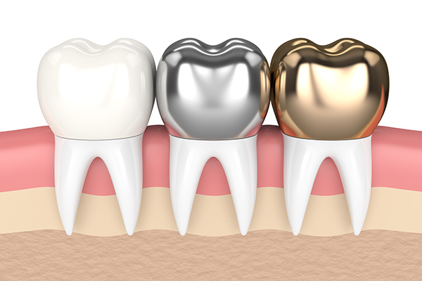 https://mydentalkraft.com/wp-content/uploads/2022/11/metal-crowns-vs-porcelain-dental-crowns.jpg