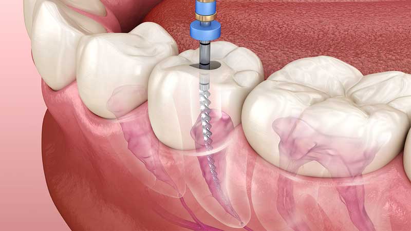 https://mydentalkraft.com/wp-content/uploads/2022/11/root-canal-procedure.jpg