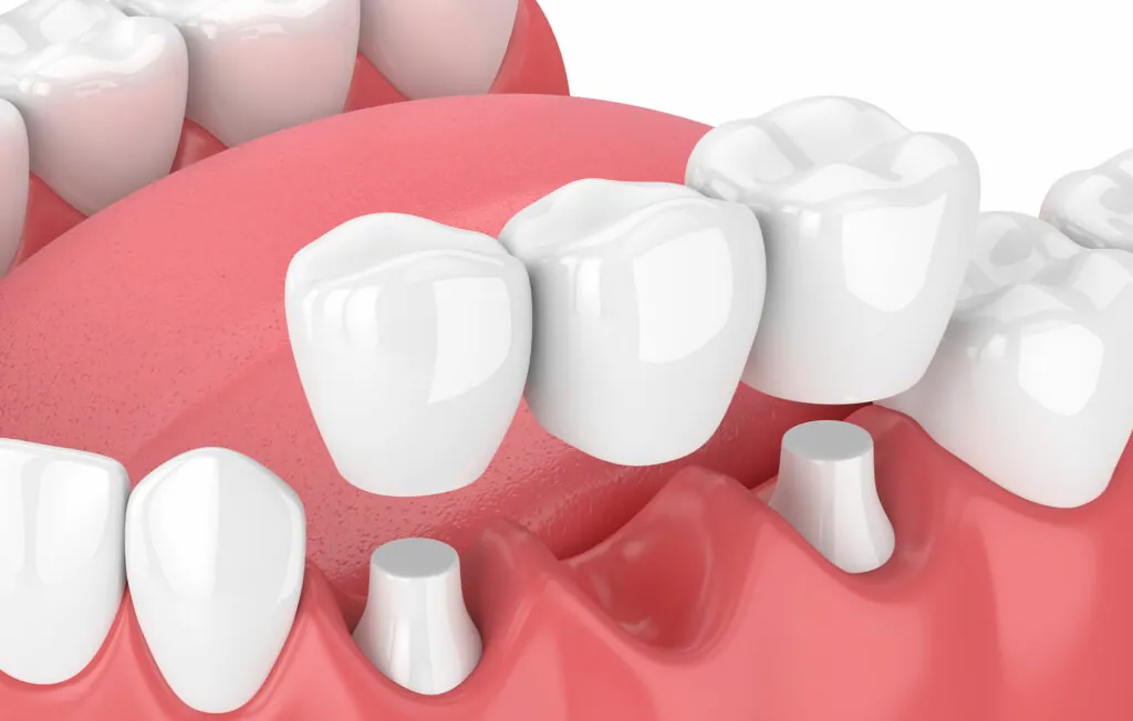 https://mydentalkraft.com/wp-content/uploads/2022/11/shutterstock_110111432008-1024x652-1.webp