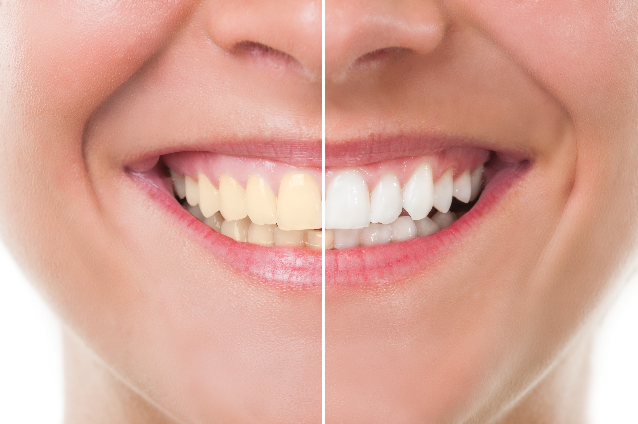 https://mydentalkraft.com/wp-content/uploads/2022/11/teeth-whitening.jpg